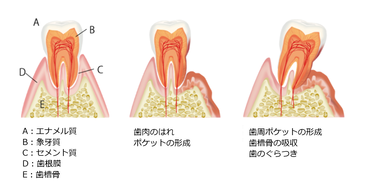 歯周病 信州メディビトネット