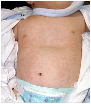 突発性発疹 信州メディビトネット